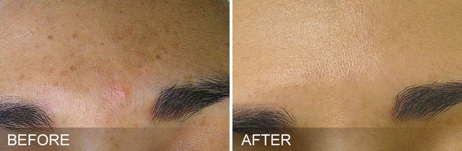 After_Before_Hydrafacial_MP_03_900